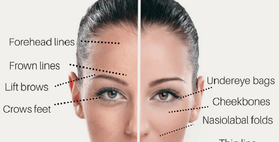 تفاوت ژل و بوتاکس